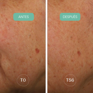 Piel con manchas visiblemente reducidas después de usar Crema noche antimanchas Alga-Biotic Laboratoires de Biarritz