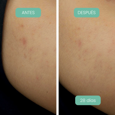 Piel con manchas visiblemente reducidas después de usar Sérum Facial antimanchas Alga-Biotic Laboratoires de Biarritz