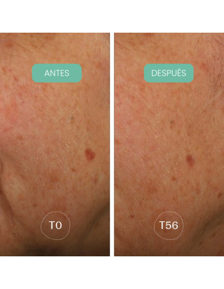 Piel con manchas visiblemente reducidas después de usar Sérum Facial antimanchas Alga-Biotic Laboratoires de Biarritz